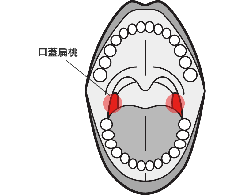 急性扁桃炎・急性咽喉頭炎