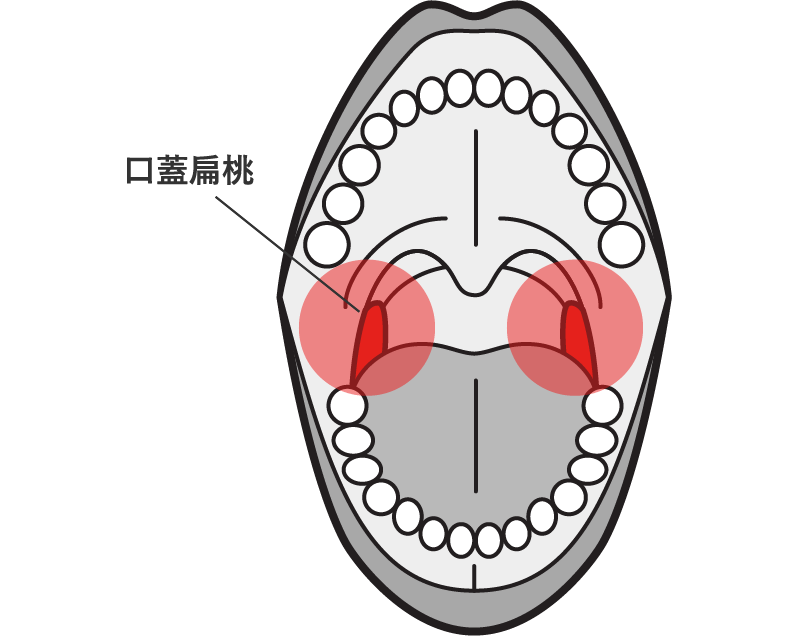 扁桃周囲炎・扁桃周囲膿瘍