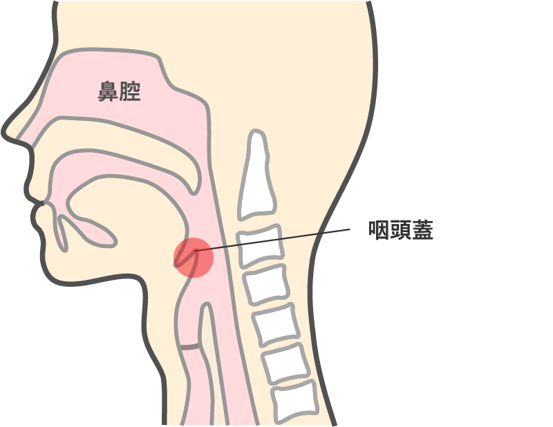 喉頭浮腫・急性喉頭蓋炎